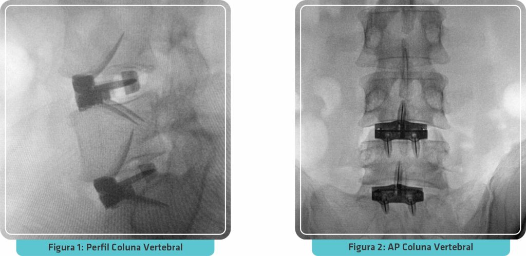 Exame de perfil para tratamento da coluna vertebral.