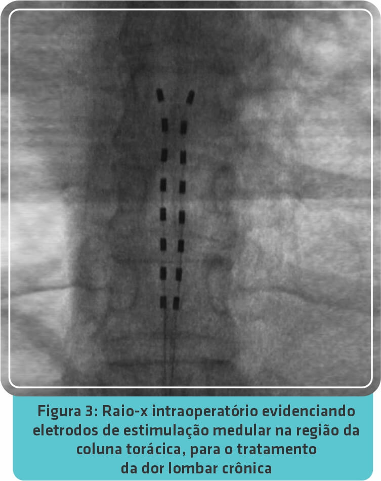 Estimulação Medular (SCS) no tratamento da dor crônica