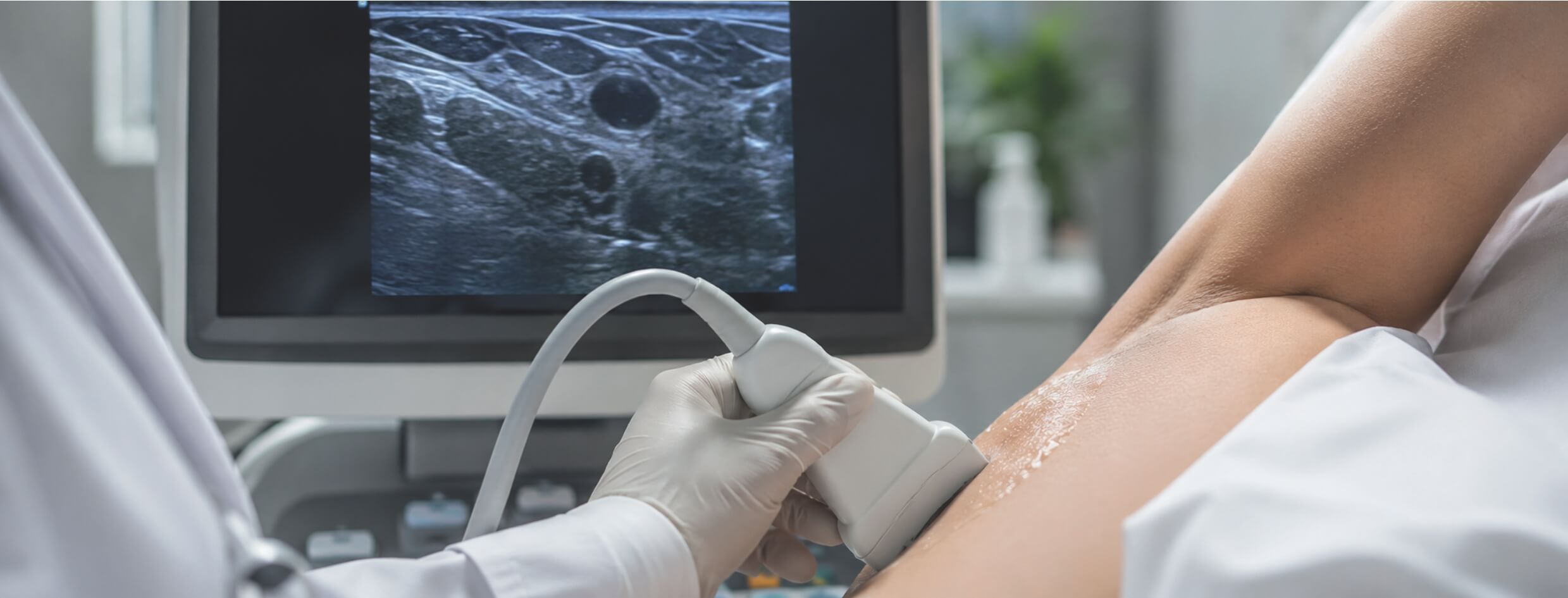 Dra Sara Joca explica o diagnostico e tratamento da hidradenite supurativa